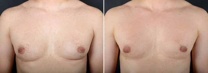 gynecomastia-16704a-sobel