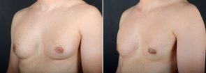 gynecomastia-16704b-sobel