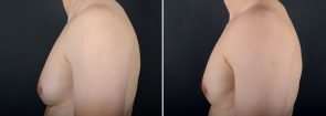 gynecomastia-16704c-sobel