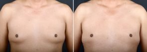 Male Chest Reduction