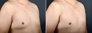 gynecomastia-16715b-sobel