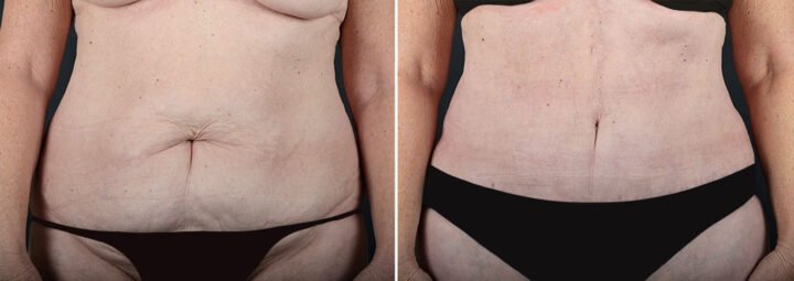 abdominoplasty-22106a