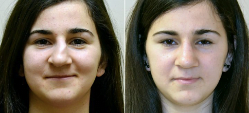 Anderson Sobel Cosmetic Surgery Deviated Septum Rhinoplasty Before and After