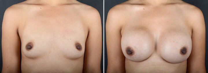 breast-augmentation-22091a