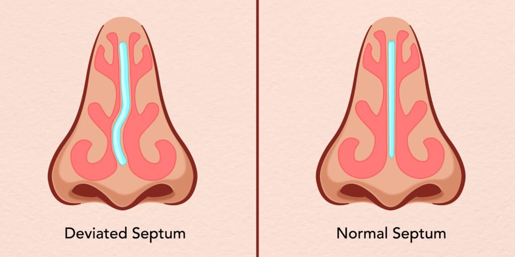 Do I Have a Deviated Septum? Anderson Sobel Cosmetic Surgery