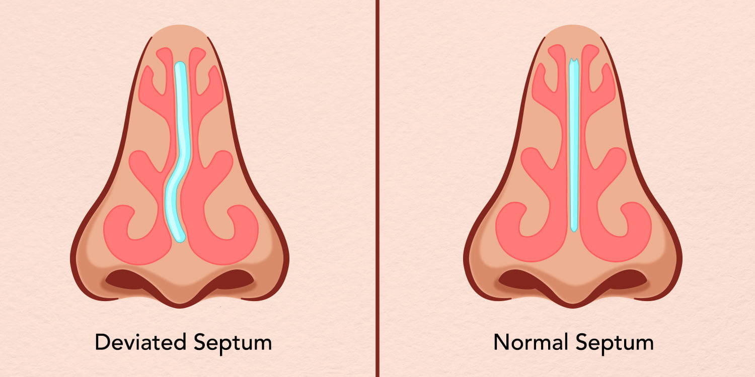 Deviated Septum Infographic - Anderson Sobel Cosmetic Surgery