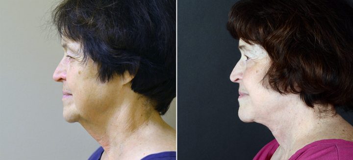 Surgical facial rejuvenation patient with restored brow, skin, neck