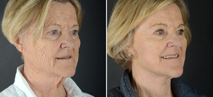 Bellevue facelift and neck lift patient before and after