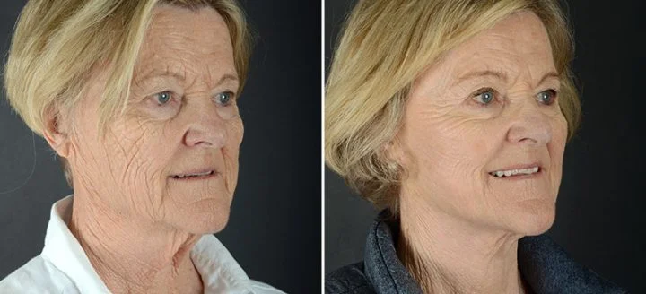 Bellevue facelift and neck lift patient before and after