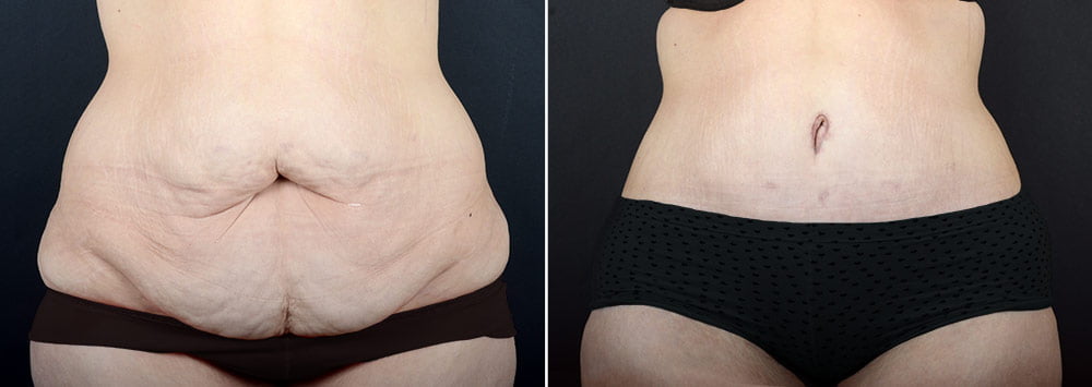 Post weight loss patient after body contouring procedures to treat several areas
