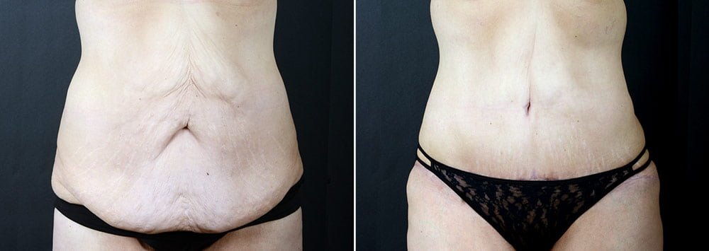 Excess skin and fat removal before and after photo
