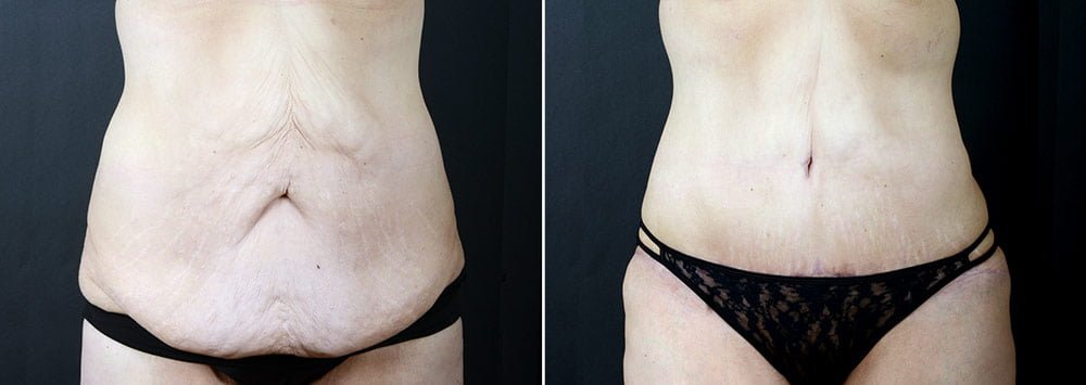 Seattle Tummy Tuck  Abdominoplasty - Anderson Sobel Cosmetic Surgery