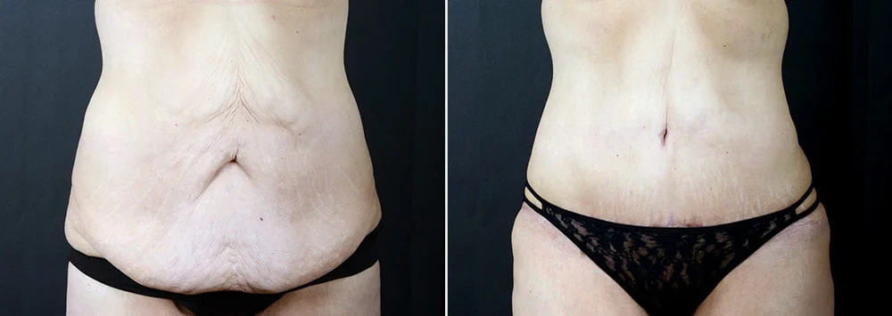 lipo during c section Abdominoplasty After C-Section main image 0