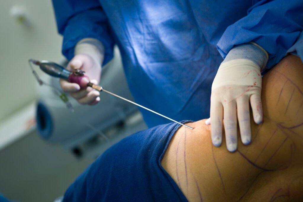 Cosmetic surgeon performing liposuction surgery