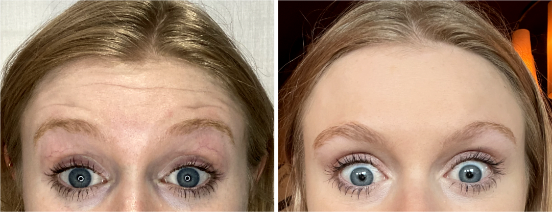 Forehead wrinkles before and after Botox injections.