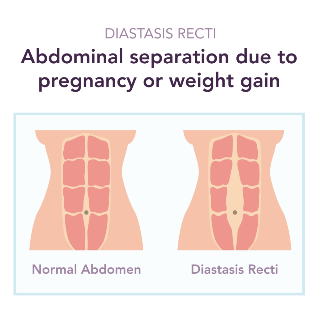 Infographic of abdominal separation (diastasis recti)