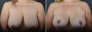Breast Lift