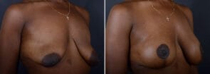 Breast Lift