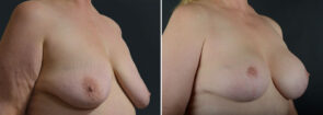 Breast Lift