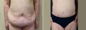 Tummy Tuck