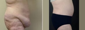 abdominoplasty-29221c-sobel
