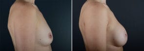 breast-augmentation-28965c-sobel