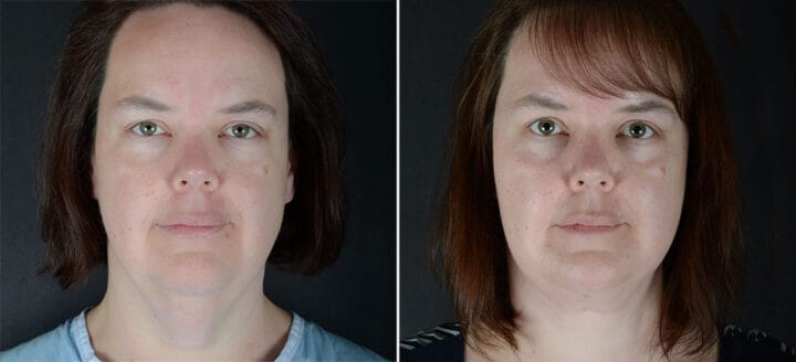 facelift-neck-lift-29186a-sobel