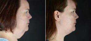 facelift-neck-lift-29186c-sobel