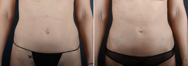 liposuction-28978a-sobel