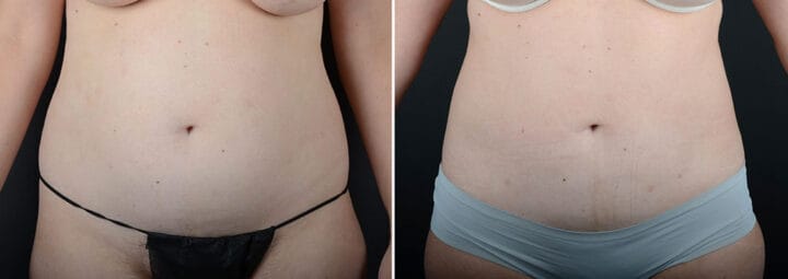 liposuction-29052a-sobel