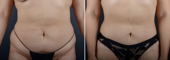 mini-tummy-tuck-liposuction-29004a-sobel
