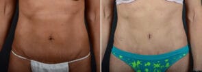 Tummy Tuck