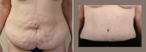 Tummy Tuck