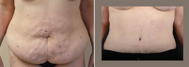 tummy-tuck-29308a-sobel