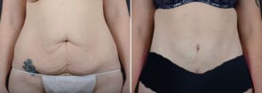 Tummy Tuck with Liposuction
