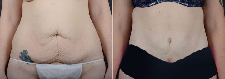 tummy-tuck-liposuction-29233a-sobel