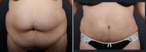 Tummy Tuck with Liposuction