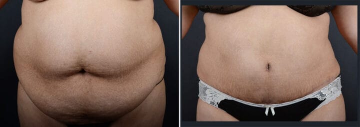 tummy-tuck-liposuction-29322a-sobel-