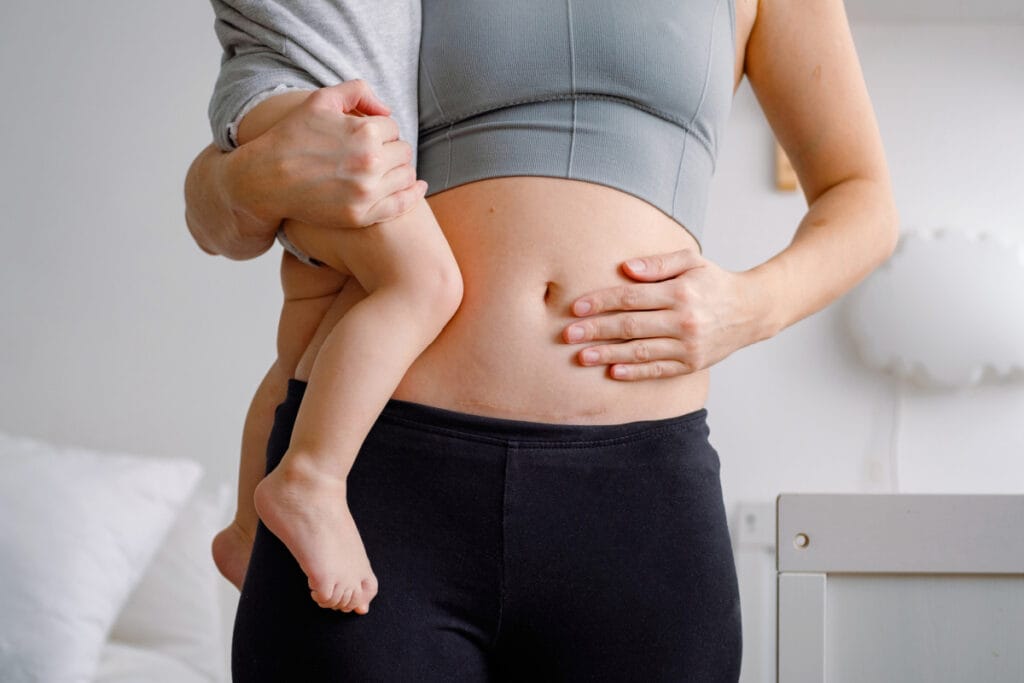 Close up of a woman holding a baby touching her stomach with a scar from c-section