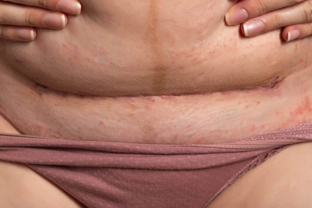 Shelf effect stomach fold after c-section