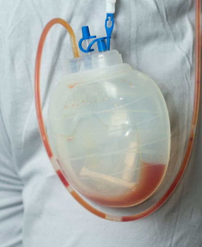 Close up of a surgical drain filled with fluid and drainage
