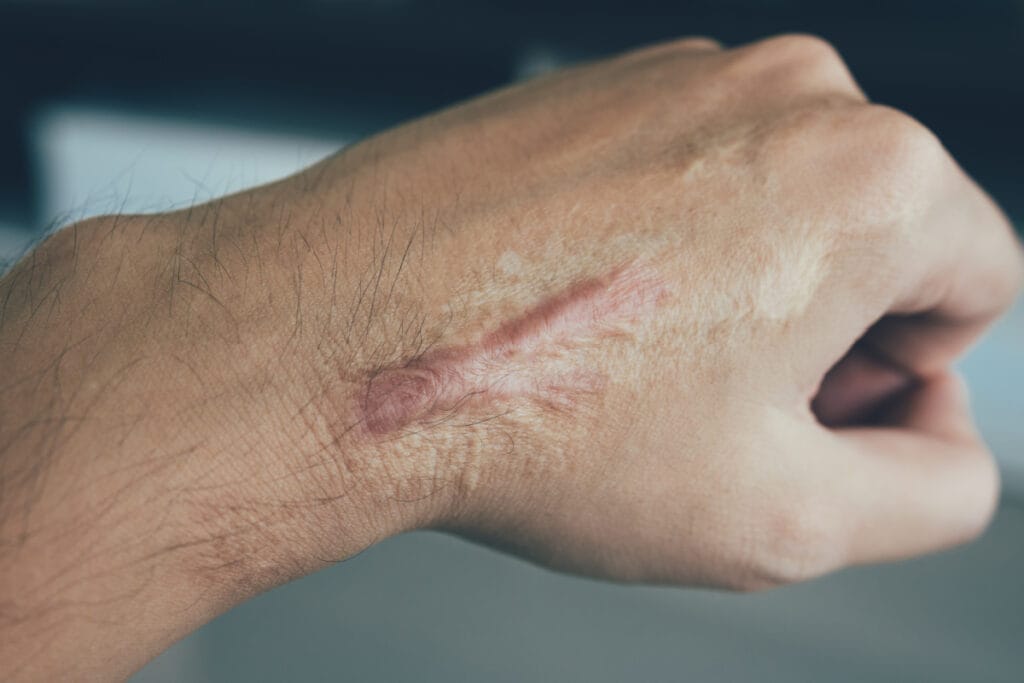 Close up of large scar keloid on man's hand