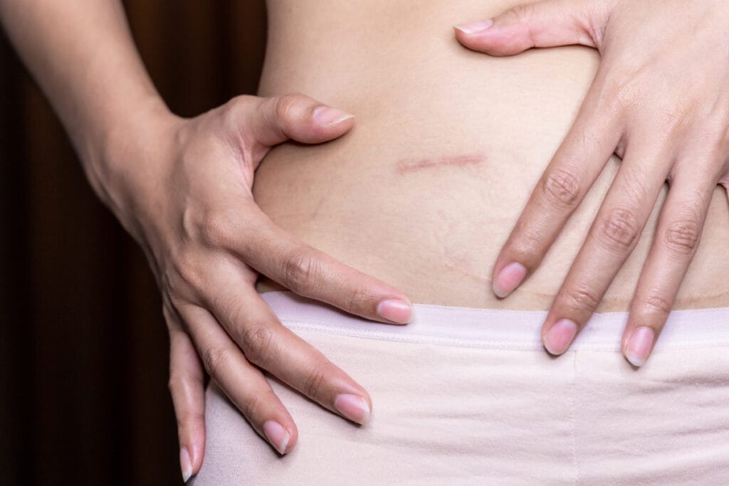 Woman with scar on abdomen