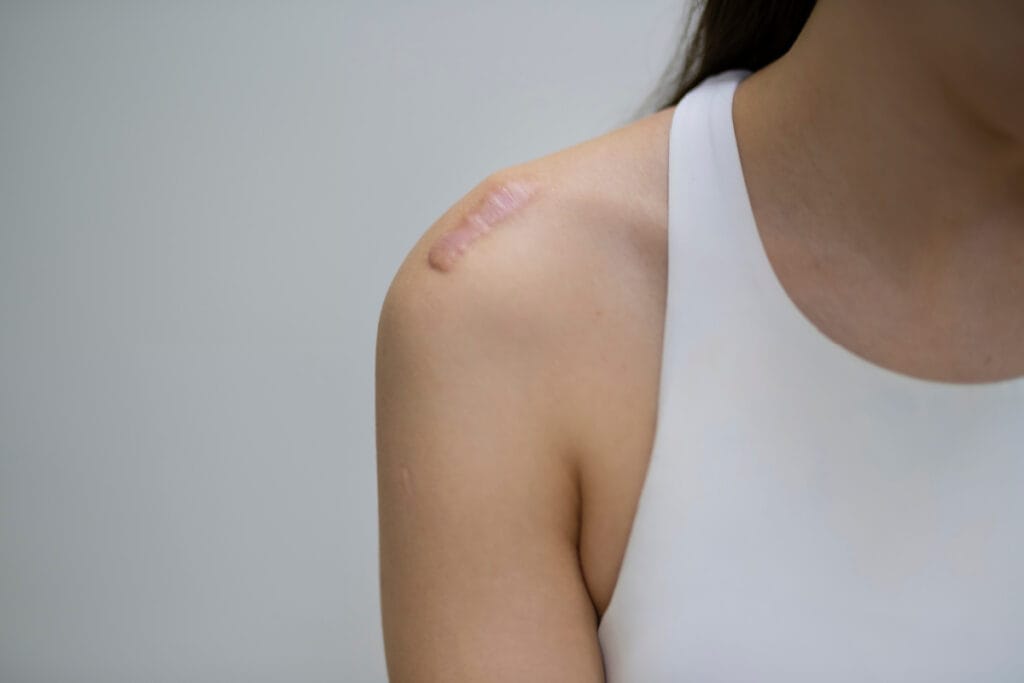 Large scar on faceless woman's shoulder