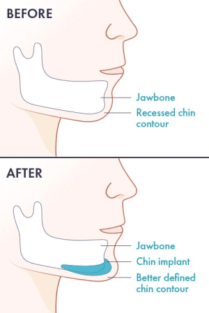 Infographic showing before and after chin implant surgery